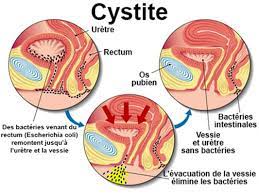 Cystite solution naturel