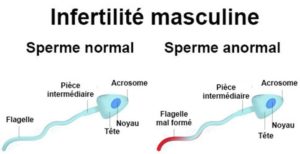 Infertilité masculine illustration