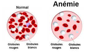 Qu'est-ce que l'anémie ? 