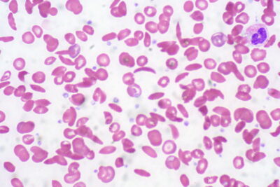 drépanocytose