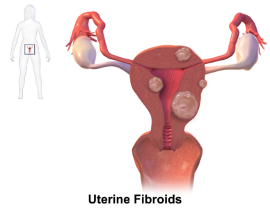 fibrôme uterin