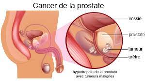 Cancer de la Prostate Traitement Naturel