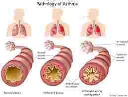 Asthme Causes Symptômes Traitement