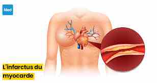 Infarctus du Myocarde : Causes Symptômes Prévention