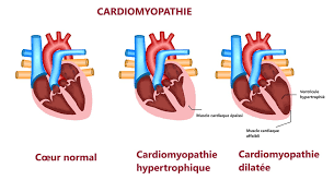 Les Types De Cardiomyopathie Traitement