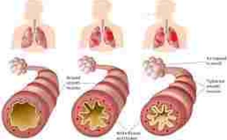 Asthme Causes Symptômes Traitement