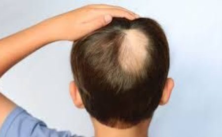 alopécie-perte de cheveux