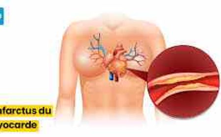 Infarctus du Myocarde : Causes Symptômes Prévention