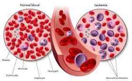 Leucémie Cancer de Sang Traitement