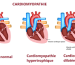 Les Types De Cardiomyopathie Traitement