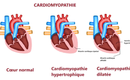 Les Types De Cardiomyopathie Traitement