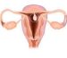 Polypes Infertilité Féminine Remède Naturel
